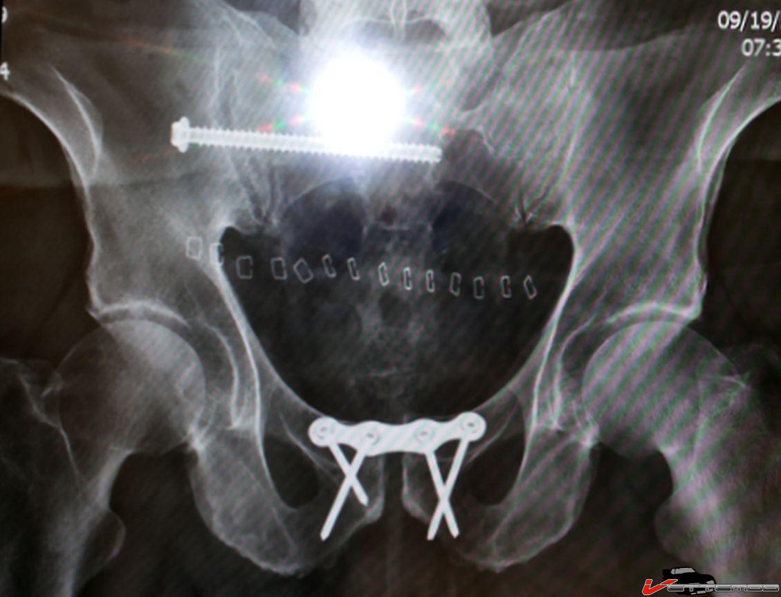 008 pelvis shot.jpg